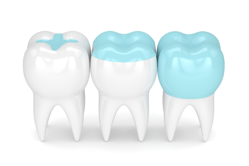 Inlay vs. Onlay | Explore Your Restorative Options in Buffalo, NY