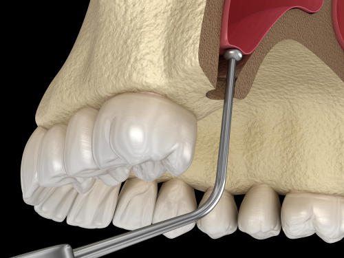 Sinus Lift Alternatives | Mini Dental Implant Solutions in Buffalo, NY