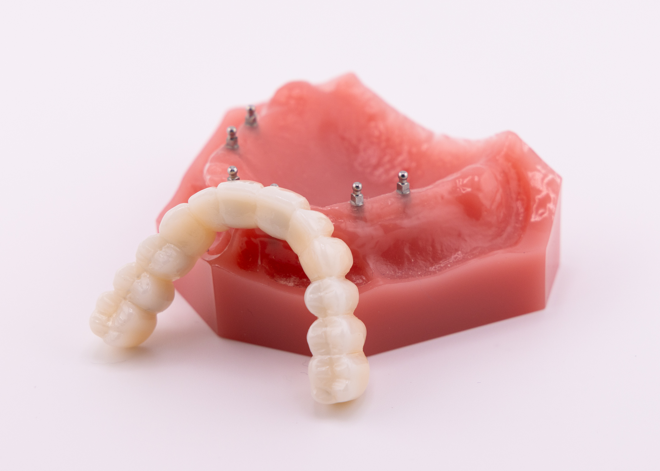 All-on-4 Alternatives in Buffalo, NY | Fix-on-Six With Mini Implants