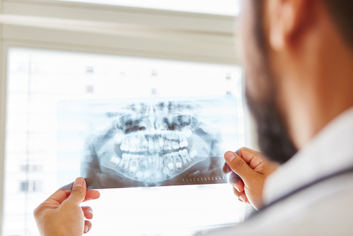 Dental Implants Before and After in Buffalo | Patient Case Study