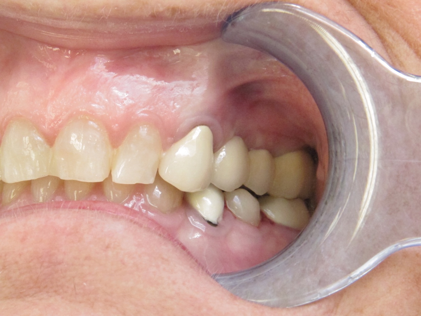 Dental Implants Before and After in Buffalo | Patient Case Study_After