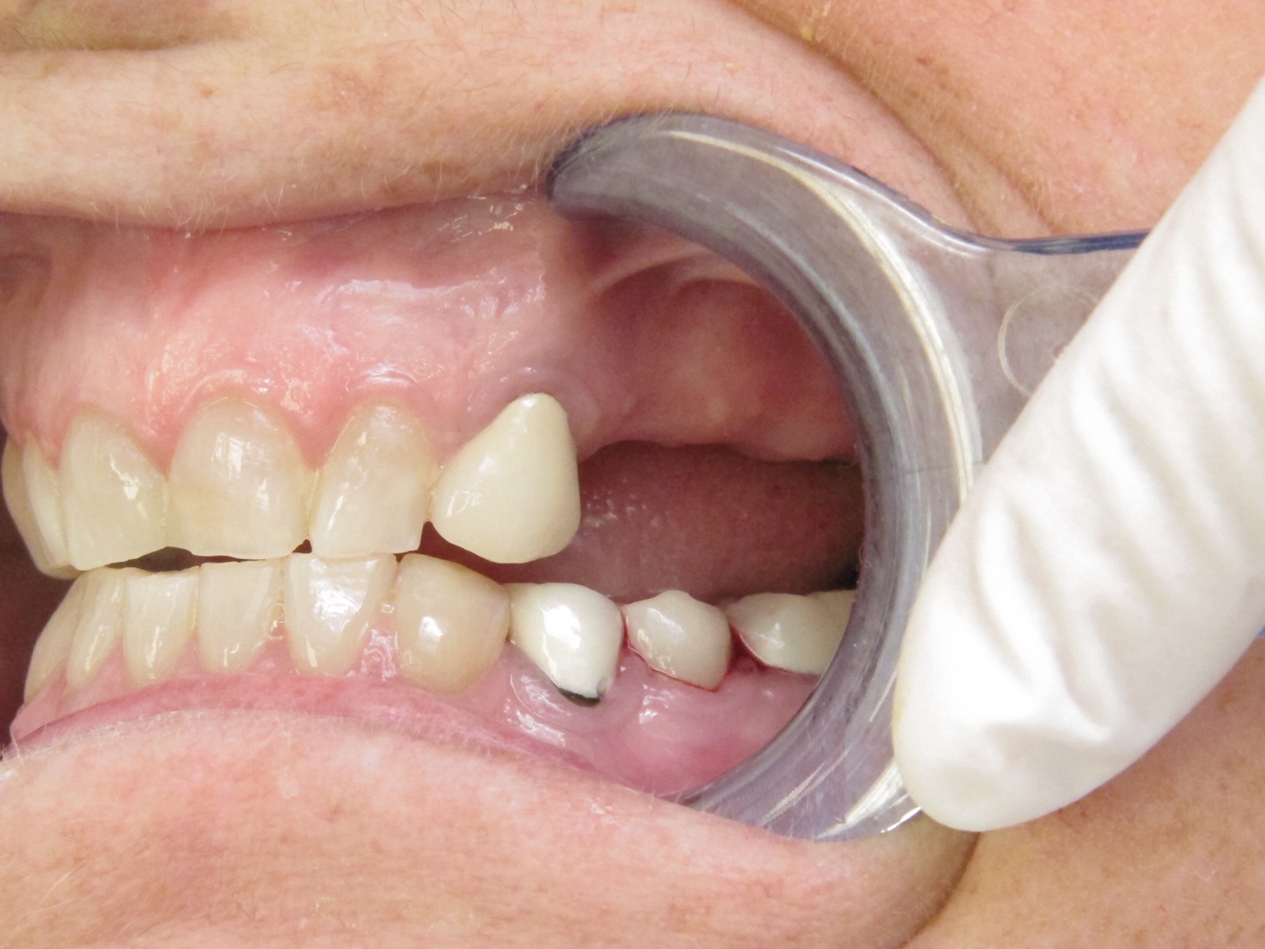 Dental Implants Before and After in Buffalo | Patient Case Study