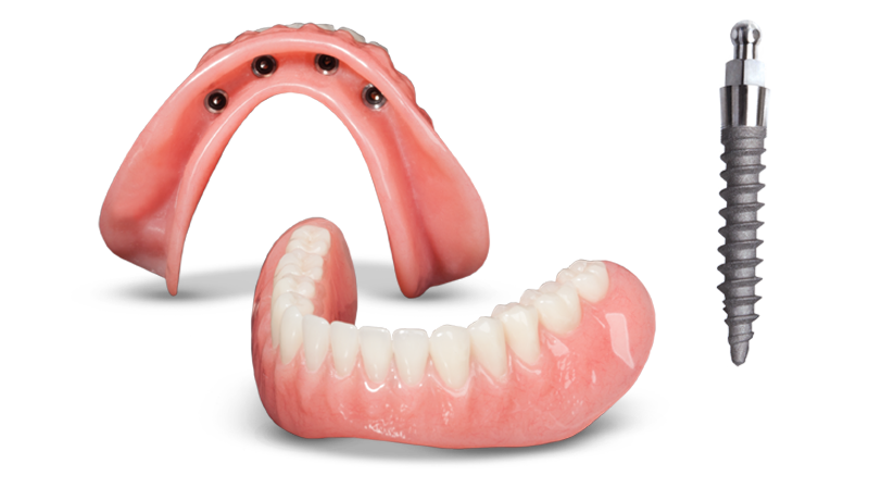 Snap-on Dentures in Buffalo, NY | Mini Implant Dentist Near Me