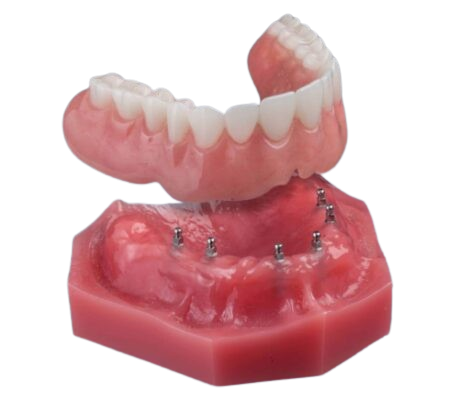 Snap-on Dentures in Buffalo, NY | Mini Implant Dentist Near Me
