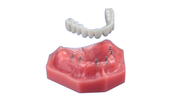 Fixed Teeth in Buffalo, NY | Affordable Implant Dentures Near Me