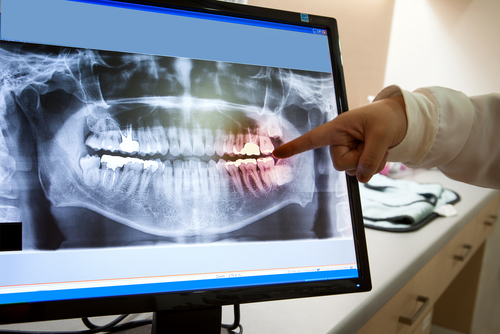 Dental Injury Treatment | Skilled Emergency Dentist in Buffalo, NY