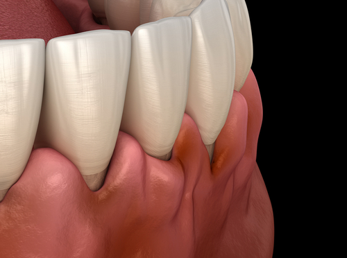 Gum Infection Symptoms | Periodontal Treatment in Bufflao, NY