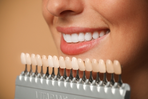Veneer Prep | Affordable Cosmetic Dentist in Buffalo, NY | Call Now