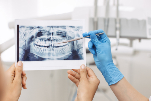 Full Mouth Dental Reconstruction in Buffalo | Free Consultations