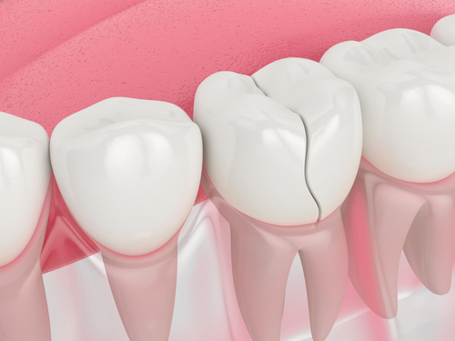 How To Fix a Broken Tooth | Emergency Dentist in Buffalo, NY