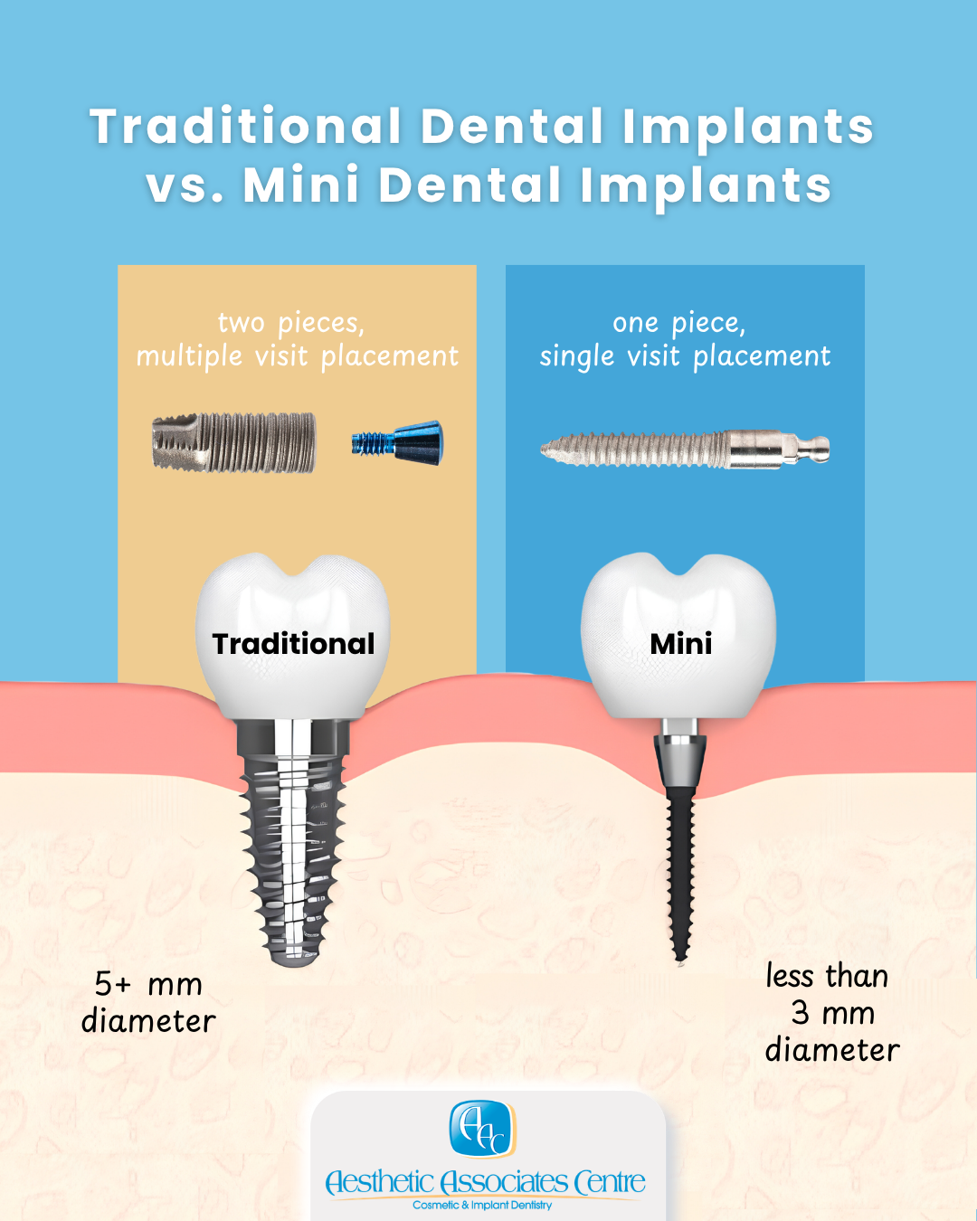 One-Piece Dental Implants in Buffalo, NY | Free Consultations