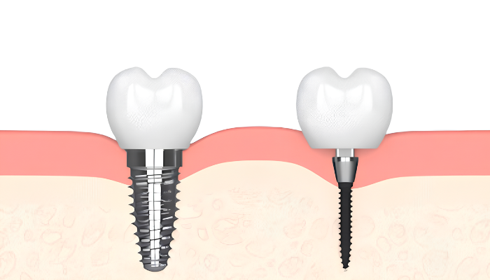 One-Piece Dental Implants in Buffalo, NY | Free Consultations