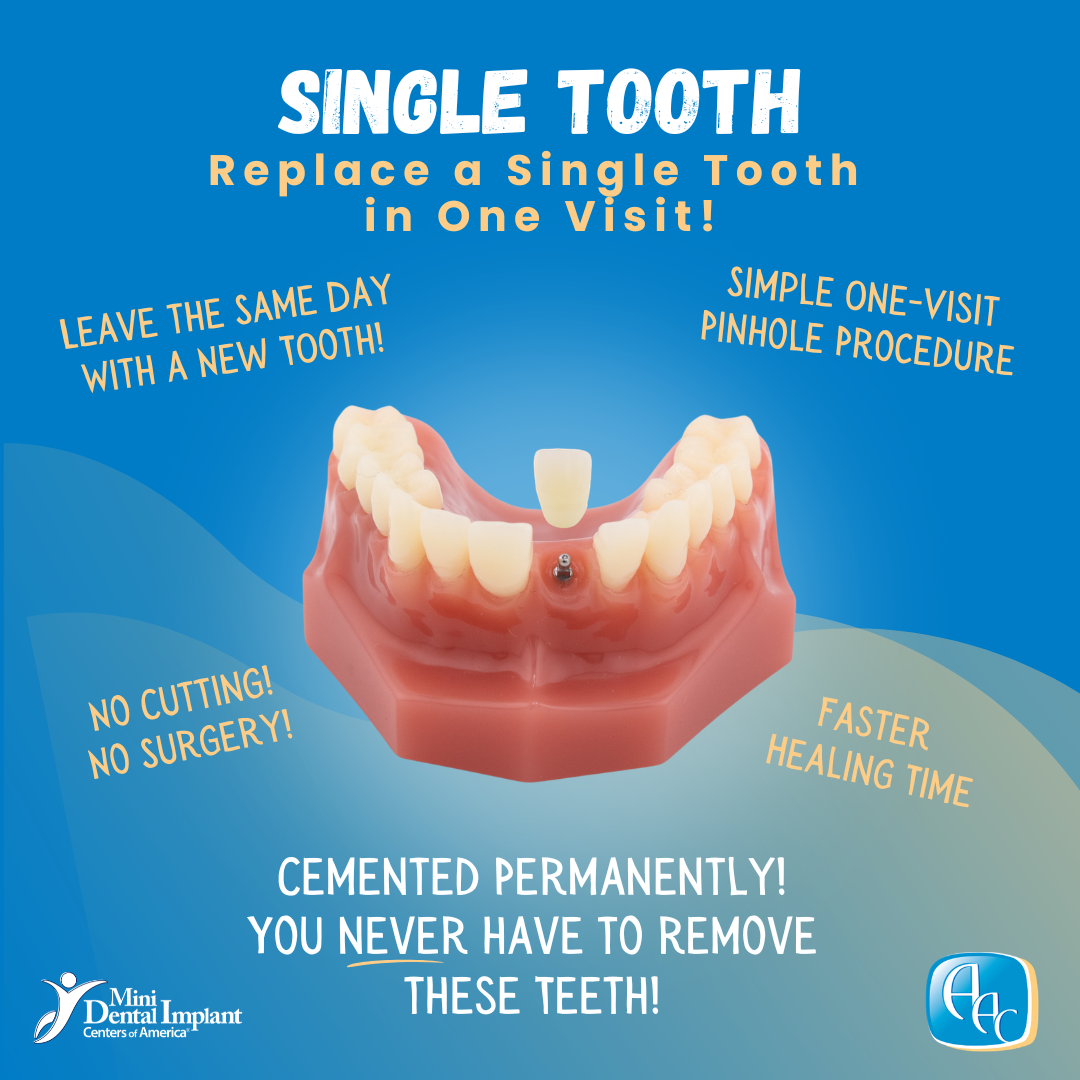 Small-Diameter Dental Implants in Buffalo, NY | Free Consultations