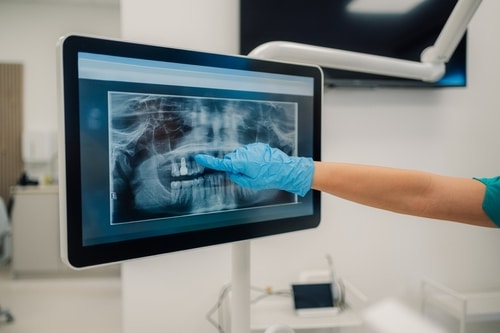Best Implant Dentist in Buffalo, NY | Book Your Free Consultation!