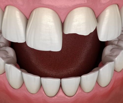 Fixing a Chipped Tooth | Skilled Emergency Dentist in Buffalo, NY
