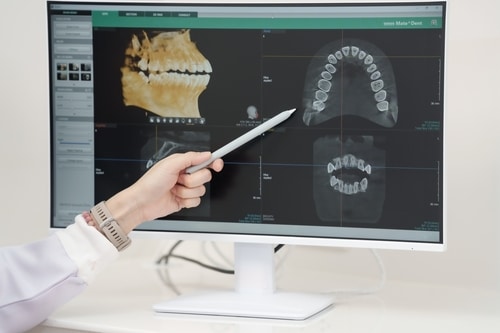 What Is a CBCT Scan? | Free Implant Consultations in Buffalo, NY